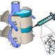 Illustration for article titled A Better Fix for Your Old, Aching Back From a New Biomaterial